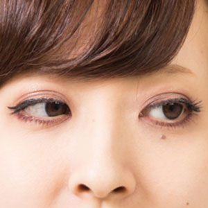 瞼のたるみ治療image