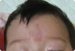 新生児 目 の 周り 赤い 目の周りの湿疹を治す方法 画像あり