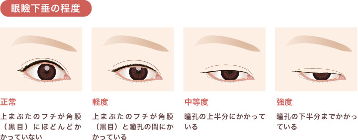 福岡で眼瞼下垂手術の相談をするなら形成外科【みやびクリニック】へ