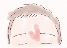 単純性血管腫‐サモンパッチ