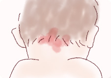 単純性血管腫‐ウンナ母斑