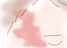 単純性血管腫‐先天性血管腫・ポートワイン母斑