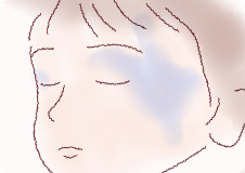 顔の青アザ‐太田母斑