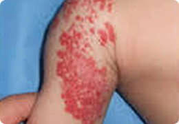 いちご状血管腫