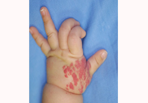 いちご状血管腫の施術前