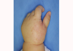 いちご状血管腫の施術後