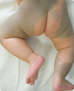 体の青あざ-異所性蒙古斑の症状