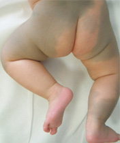 Qスイッチレーザーによる施術前