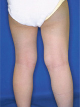 Qスイッチレーザーによる施術後