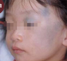 Qスイッチレーザーによる施術前