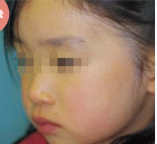 Qスイッチレーザーによる施術後