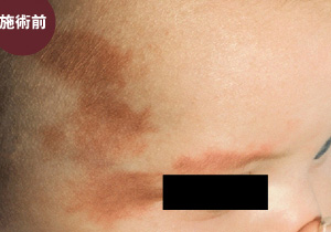 色素レーザー(Vビーム)による施術前