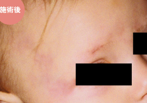 色素レーザー(Vビーム)による施術後