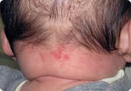 ウンナ母斑の症状